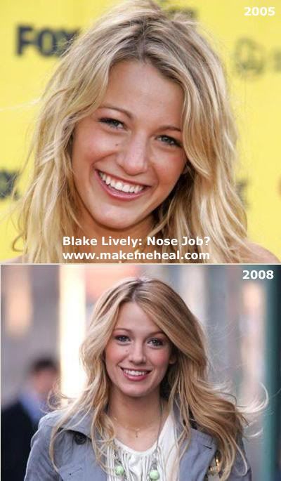 blake lively nose job before after. Blake Lively Nose Before And